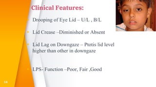Clinical Features:
▸ Drooping of Eye Lid – U/L , B/L
▸ Lid Crease –Diminished or Absent
▸ Lid Lag on Downgaze – Ptotis lid level
higher than other in downgaze
▸ LPS- Function –Poor, Fair ,Good
14
 