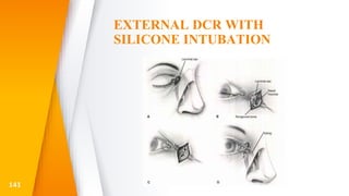 EXTERNAL DCR WITH
SILICONE INTUBATION
141
 