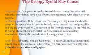 The Droopy Eyelid May Cause:
▸ Astigmatism- If the pressure on the front of the eye causes distortion and
refractive error it may need close observation, treatment with glasses or even
surgery.
▸ A chin up position- If the ptosis is severe enough it may cause the child to
adopt a chin up position in order to be able to see beneath the droopy eyelids
and use the eyes together. Contraction of the frontalis muscle (in the forehead)
to further elevate the upper eyelid is a very common compensatory
mechanism. This is also an indication for surgical correction.
▸ Amblyopia (abnormal visual development)- This results from astigmatism (a
misshaping of the cornea) or other refractive errors (refractive amblyopia).
(Stimulus deprivation amblyopia).
15
 