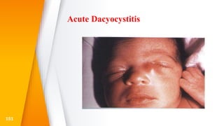 Acute Dacyocystitis
151
 