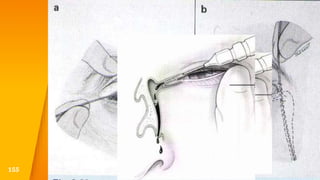 Irrigation Of Nasolacrimal System
155
 