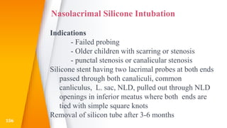Nasolacrimal Silicone Intubation
Indications
- Failed probing
- Older children with scarring or stenosis
- punctal stenosis or canalicular stenosis
Silicone stent having two lacrimal probes at both ends
passed through both canaliculi, common
canliculus, L. sac, NLD, pulled out through NLD
openings in inferior meatus where both ends are
tied with simple square knots
Removal of silicon tube after 3-6 months
156
 