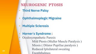 NEUROGENIC PTOSIS
▸ Third Nerve Palsy
▸ Ophthalmoplegic Migraine
▸ Multiple Sclerosis
▸ Horner’s Syndrome :
▸ Oculosympathetic Paresis
▸ Mild Ptosis (Muller Muscle Paralysis )
▸ Miosis ( Dilator Pupillae paralysis )
▸ Reduced Iplsilateral sweating
▸ Enophthalmos
19
 