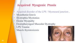 Acquired Myogenic Ptosis
▸ Acquired disorder of the LPS / Myoneural junction .
▸ Myasthenia Gravis
▸ Dystrophia Myotonica
▸ Ocular Myopathy
▸ Oculopharyngeal Muscular Dystrophy
▸ LPS Trauma
▸ Muscle thyrotoxicosis
21
 