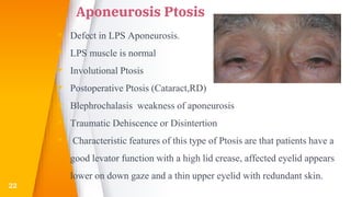 Aponeurosis Ptosis
▸ Defect in LPS Aponeurosis.
▸ LPS muscle is normal
▸ Involutional Ptosis
▸ Postoperative Ptosis (Cataract,RD)
▸ Blephrochalasis weakness of aponeurosis
▸ Traumatic Dehiscence or Disintertion
▸ Characteristic features of this type of Ptosis are that patients have a
good levator function with a high lid crease, affected eyelid appears
lower on down gaze and a thin upper eyelid with redundant skin.
22
 