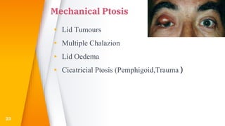 Mechanical Ptosis
▸ Lid Tumours
▸ Multiple Chalazion
▸ Lid Oedema
▸ Cicatricial Ptosis (Pemphigoid,Trauma )
23
 