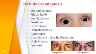 Exclude Pseudoptosis
▸ Microphthalmos
▸ Pthisis Bulbi
▸ Enophthalmos
▸ Prosthesis
▸ Brow Ptosis
▸ Dermatochalasis
▸ Hypotropia
▸ Contralateral – Eye lid Retraction
▸ High Myopia
▸ Proptosis
25
 