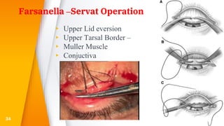 Farsanella –Servat Operation
▸ Upper Lid eversion
▸ Upper Tarsal Border –
▸ Muller Muscle
▸ Conjuctiva
34
 