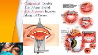 ▸ Conjuctival - Double
Evert Upper Eyelid
▸ Skin Approach Incision
along Lid Crease
37
 