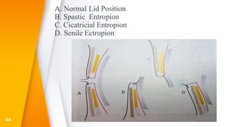 A. Normal Lid Position
B. Spastic Entropion
C. Cicatricial Entropion
D. Senile Ectropion
44
 