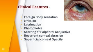 Clinical Features -
▸ Foreign Body sensation
▸ Irritaion
▸ Lacrimation
▸ Photophobia
▸ Scarring of Palpebral Conjuctiva
▸ Recurrent corneal abrasion
▸ Superficial corneal Opacity
50
 