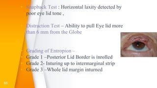▸ Snapback Test : Horizontal laxity detected by
poor eye lid tone ,
▸ Distraction Test – Ability to pull Eye lid more
than 6 mm from the Globe
▸ Grading of Entropion –
▸ Grade 1 –Posterior Lid Border is inrolled
▸ Grade 2- Inturing up to intermarginal strip
▸ Grade 3 –Whole lid margin inturned
51
 