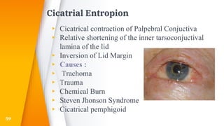 Cicatrial Entropion
▸ Cicatrical contraction of Palpebral Conjuctiva
▸ Relative shortening of the inner tarsoconjuctival
lamina of the lid
▸ Inversion of Lid Margin
▸ Causes :
▸ Trachoma
▸ Trauma
▸ Chemical Burn
▸ Steven Jhonson Syndrome
▸ Cicatrical pemphigoid
59
 
