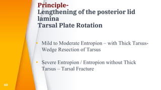 Principle-
Lengthening of the posterior lid
lamina
Tarsal Plate Rotation
▸ Mild to Moderate Entropion – with Thick Tarsus-
Wedge Resection of Tarsus
▸ Severe Entropion / Entropion without Thick
Tarsus – Tarsal Fracture
60
 