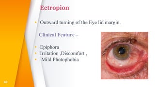 Ectropion
▸ Outward turning of the Eye lid margin.
Clinical Feature –
▸ Epiphora
▸ Irritation ,Discomfort ,
▸ Mild Photophobia
62
 