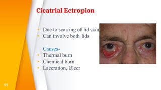 Cicatrial Ectropion
▸ Due to scarring of lid skin
▸ Can involve both lids
Causes-
▸ Thermal burn
▸ Chemical burn
▸ Laceration, Ulcer
64
 