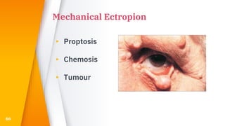 Mechanical Ectropion
▸ Proptosis
▸ Chemosis
▸ Tumour
66
 