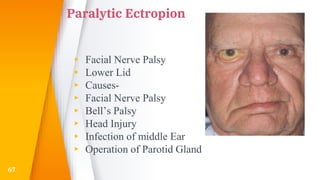 Paralytic Ectropion
▸ Facial Nerve Palsy
▸ Lower Lid
▸ Causes-
▸ Facial Nerve Palsy
▸ Bell’s Palsy
▸ Head Injury
▸ Infection of middle Ear
▸ Operation of Parotid Gland
67
 
