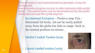 If the ectropion is not cicatricial and not paralytic, it must be
involutional.
Involutional ectropion occurs in older patients with eyelid
laxity . The eyelid laxity can be demonstrated by the eyelid
distraction test and the eyelid snap test
▸ Involutional Ectropion – Positive snap Test –
Horizontal lid laxity ,lid can be easily pulled
away from the globe but fails to snape back to
the normal position on release .
▸ Medial Canthal Tendon laxity
▸ Lateral canthal tendon Laxity69
 