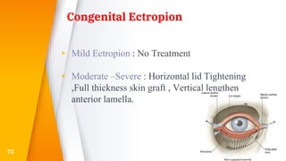 Congenital Ectropion
▸ Mild Ectropion : No Treatment
▸ Moderate –Severe : Horizontal lid Tightening
,Full thickness skin graft , Vertical lengthen
anterior lamella.
73
 