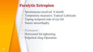 Paralytic Ectropion
▸ Spontaneous resolved 6 month
▸ Temprarory measures: Topical Lubricant
▸ Taping temporal side of eye lid
▸ Suture tarsorrhaphy
▸ Permanent :
▸ Horizontal lid tightening
▸ Palpebral sling Operation
74
 
