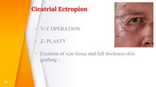 Cicatrial Ectropion
▸ V-Y OPERATION
▸ Z- PLASTY
▸ Excision of scar tissue and full thickness skin
grafting -
75
 