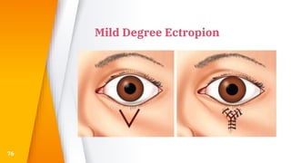 Mild Degree Ectropion
76
 