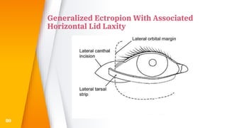 Generalized Ectropion With Associated
Horizontal Lid Laxity
80
 