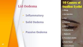 Lid Oedema
▸ Inflammatory
▸ Solid Oedema
▸ Passive Oedema
87
 
