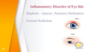 Inflammatory Disorder of Eye lids
▸ Blephritis – Anterior , Posterior ( Meibomitis)
▸ External Hordeolum
90
 