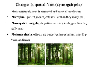 Changes in spatial form (dysmegalopsia)
Most commonly seen in temporal and parietal lobe lesion
• Micropsia- patient sees objects smaller than they really are.
• Macropsia or megalopsia patient sees objects bigger than they
really are.
• Metamorphosia objects are perceived irregular in shape. E.g-
Macular disease
 