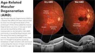 Age-Related
Macular
Degeneration
(AMD)
Age-Related Macular Degeneration (AMD) is
a disease that affects the eyes and can lead
to vision loss through break down of the
central part of the retina called the macula.
Degeneration can occur in one eye or both
and can be classified as either wet
(neovascular) or dry (atrophic). Wet AMD
commonly is caused by blood vessels near
the retina that lead to swelling of the
macula. The cause of dry AMD is less clear,
but it is thought to be partly caused by
breakdown of light-sensitive cells and tissue
surrounding the macula. A major risk factor
for AMD is age over the age of 60.
 
