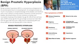 Benign Prostatic Hyperplasia
(BPH)
Benign prostatic hyperplasia (BPH) is a noncancerous enlargement of
the prostate gland due to increased growth. An enlarged prostate can
result in incomplete or complete blockage of the bladder and interferes
with a man's ability to urinate properly. Symptoms include overactive
bladder, decreased stream of urine, hesitancy urinating, and
incomplete emptying of the bladder. By age 40, 10% of men will have
signs of BPH and by age 60, this percentage increases by 5 fold. Men
over the age of 80 have over a 90% chance of developing BPH and
almost 80% of men will develop BPH in their lifetime.
 