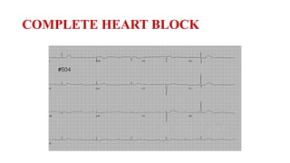 Disorders of Conduction of Heart- Interpretation and Management | PPTX