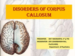 DISORDERS OF CORPUS
     CALLOSUM



        PRESENTER: DR T RAVIKANTH, 1st yr PG
        MODERATOR : DR V.SHARBANDH RAJ,
                    Prof & HOD,
                     Department of Psychiatry
 