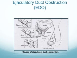 Ejaculatory Duct Obstruction
(EDO)
Causes of ejaculatory duct obstruction.
 