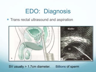 EDO: Diagnosis
 Trans rectal ultrasound and aspiration
SV usually > 1.7cm diameter. Billions of sperm
 
