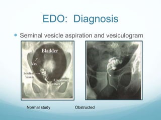 EDO: Diagnosis
 Seminal vesicle aspiration and vesiculogram
Normal study Obstructed
 