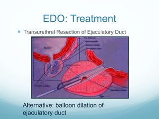 EDO: Treatment
 Transurethral Resection of Ejaculatory Duct
Alternative: balloon dilation of
ejaculatory duct
 