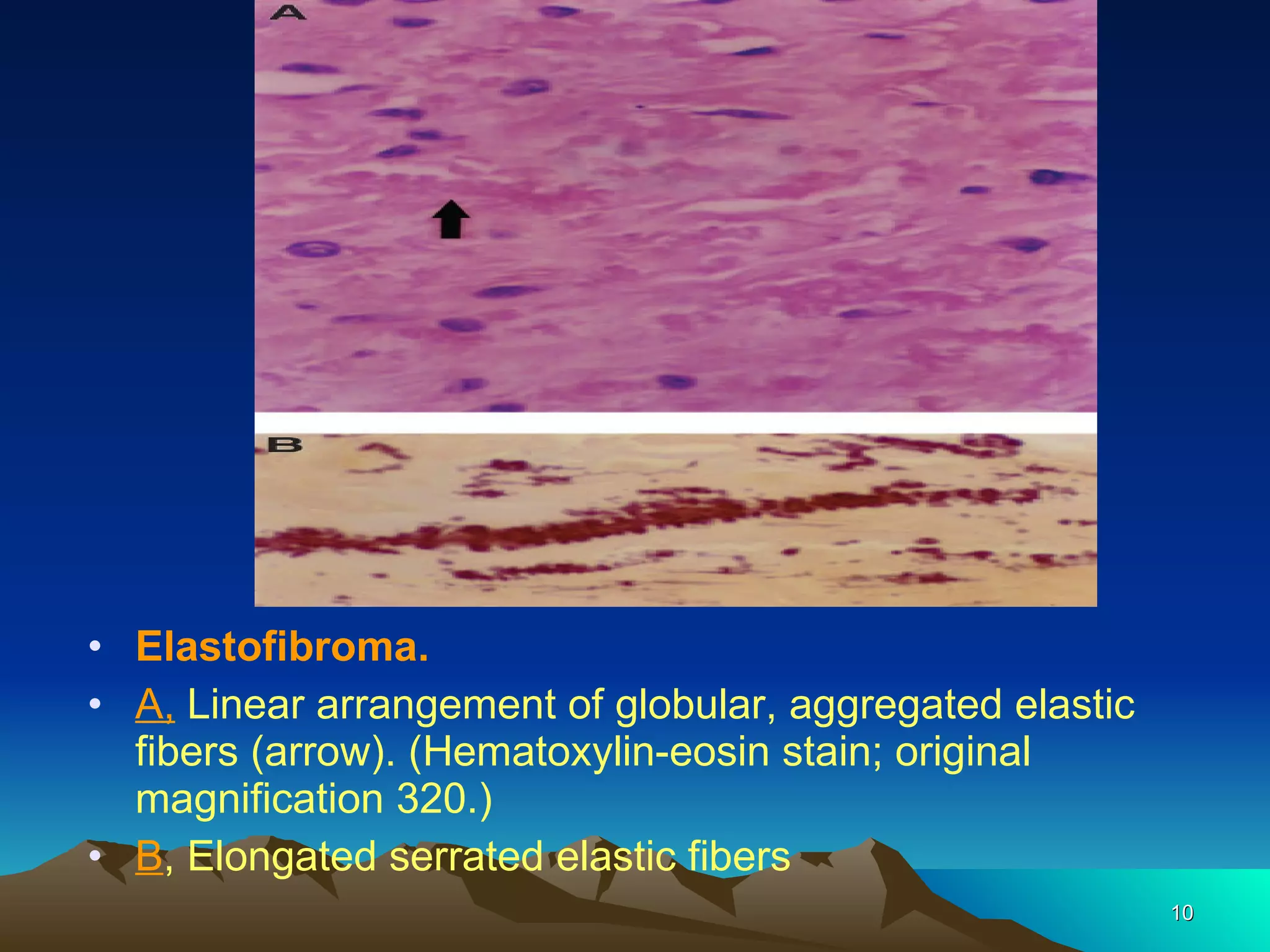 Elastofibroma.  A,   Linear arrangement of globular, aggregated elastic fibers (arrow). (Hematoxylin-eosin   stain; original magnification 320.)  B , Elongated serrated elastic fibers 
