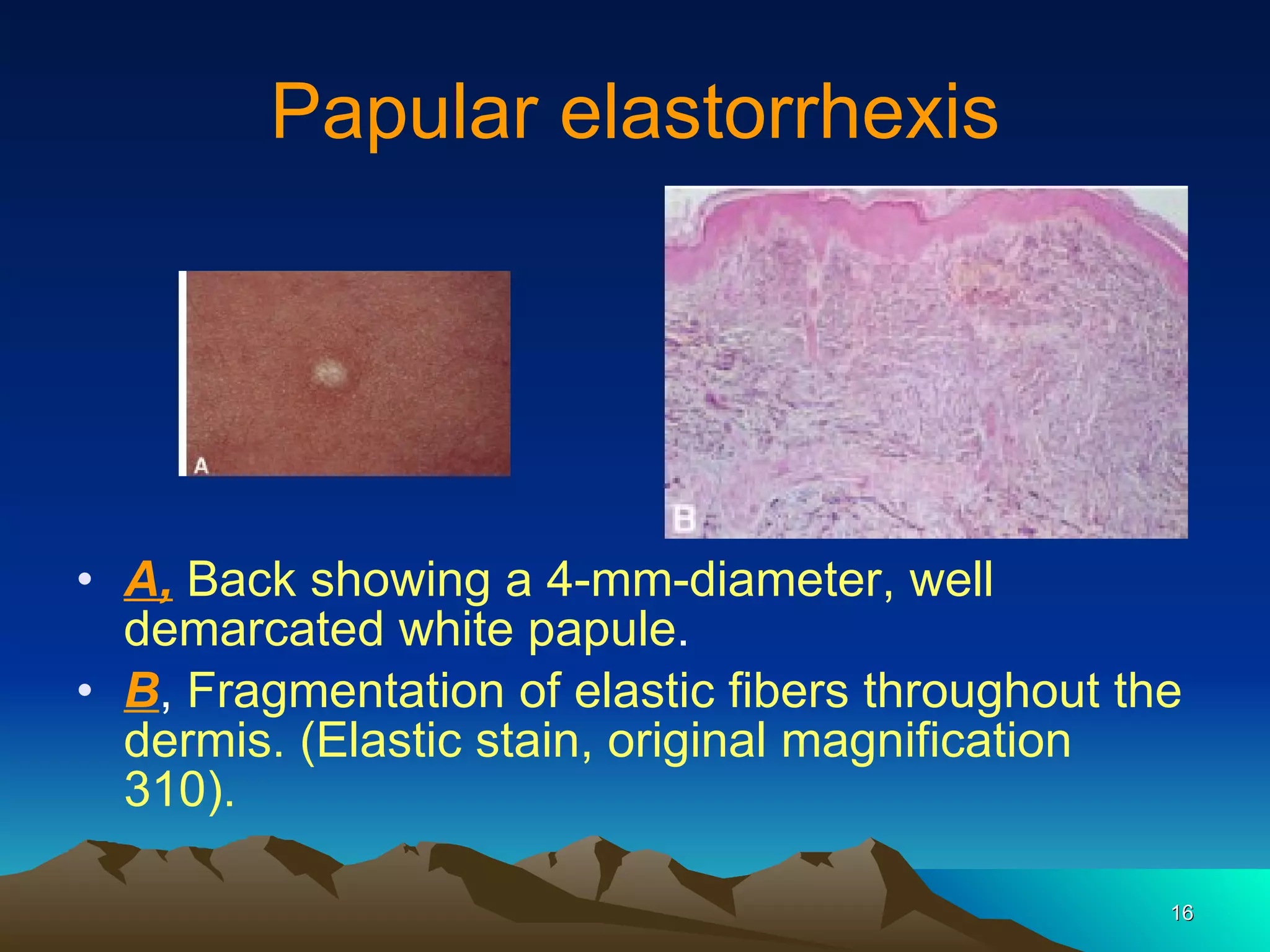 Papular elastorrhexis A,   Back showing a 4-mm-diameter, well demarcated white papule . B ,  Fragmentation of elastic fibers throughout the dermis. (Elastic stain, original magnification 310). 
