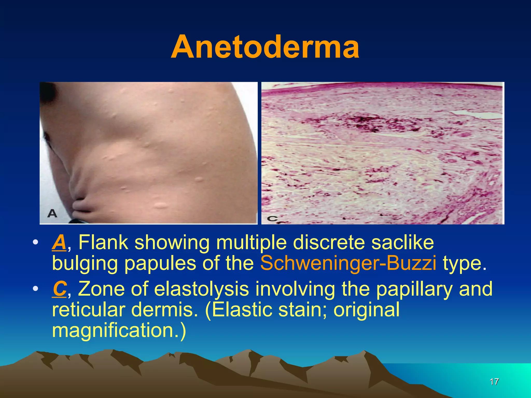 Anetoderma A ,  Flank showing multiple discrete saclike bulging papules of the  Schweninger-Buzzi  type . C ,  Zone of elastolysis involving the papillary and reticular dermis. (Elastic stain; original magnification.) 