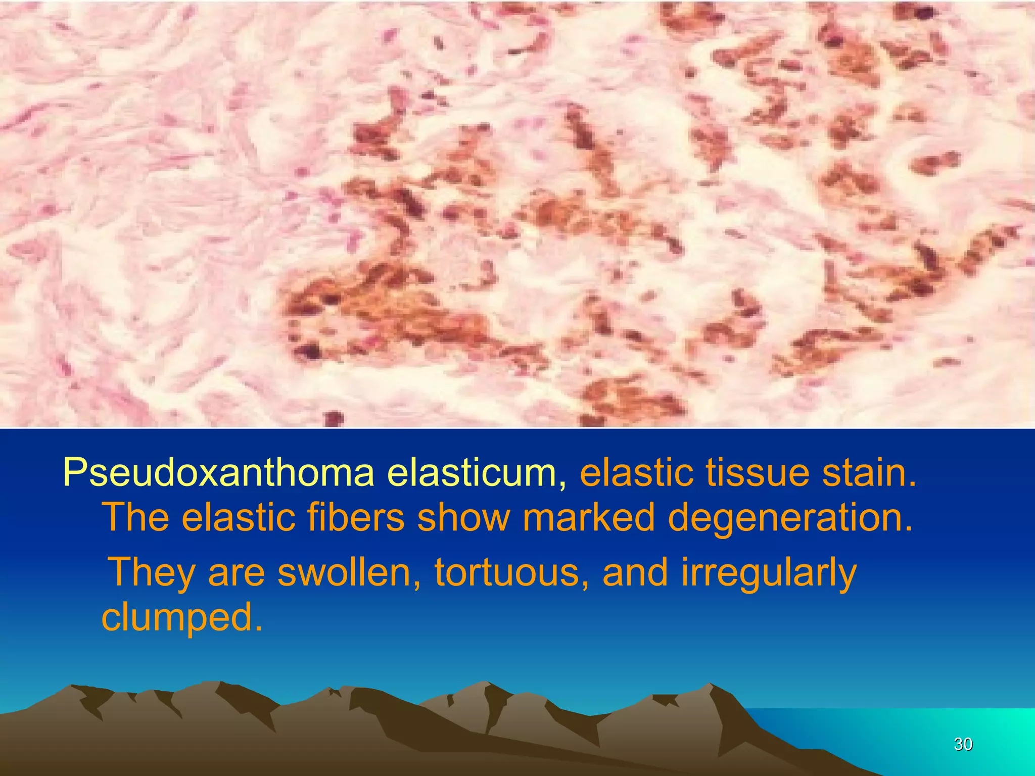 Pseudoxanthoma elasticum,  elastic tissue stain. The elastic fibers show marked degeneration. They are swollen, tortuous, and irregularly clumped. 