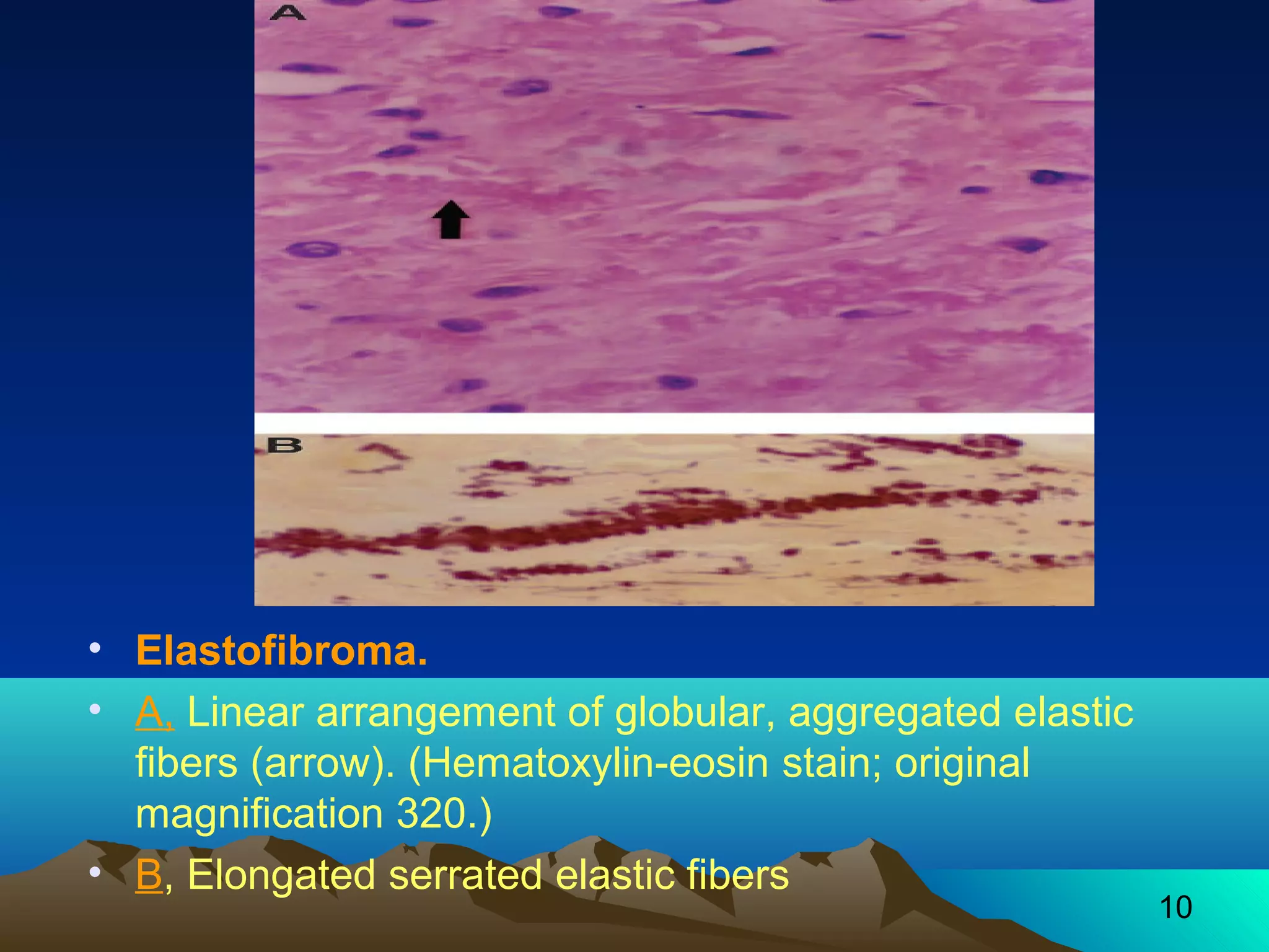10 
• Elastofibroma. 
• A, Linear arrangement of globular, aggregated elastic 
fibers (arrow). (Hematoxylin-eosin stain; original 
magnification 320.) 
• B, Elongated serrated elastic fibers 
 