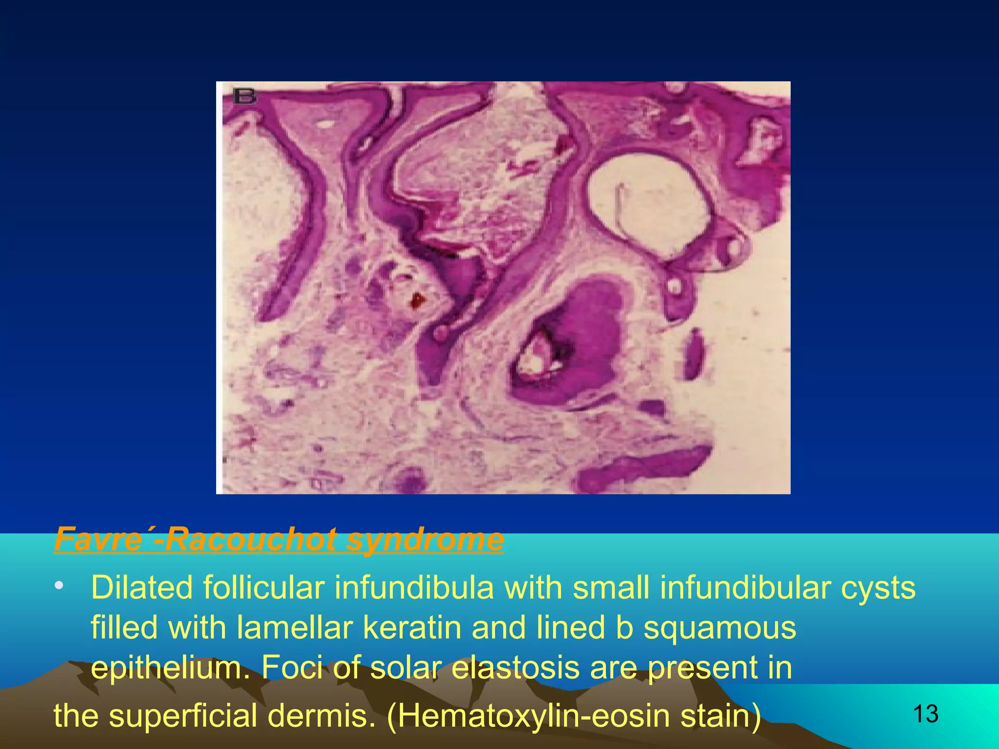 Favre´-Racouchot syndrome 
• Dilated follicular infundibula with small infundibular cysts 
filled with lamellar keratin and lined b squamous 
epithelium. Foci of solar elastosis are present in 
the superficial dermis. (Hematoxylin-eosin stain) 
13 
 