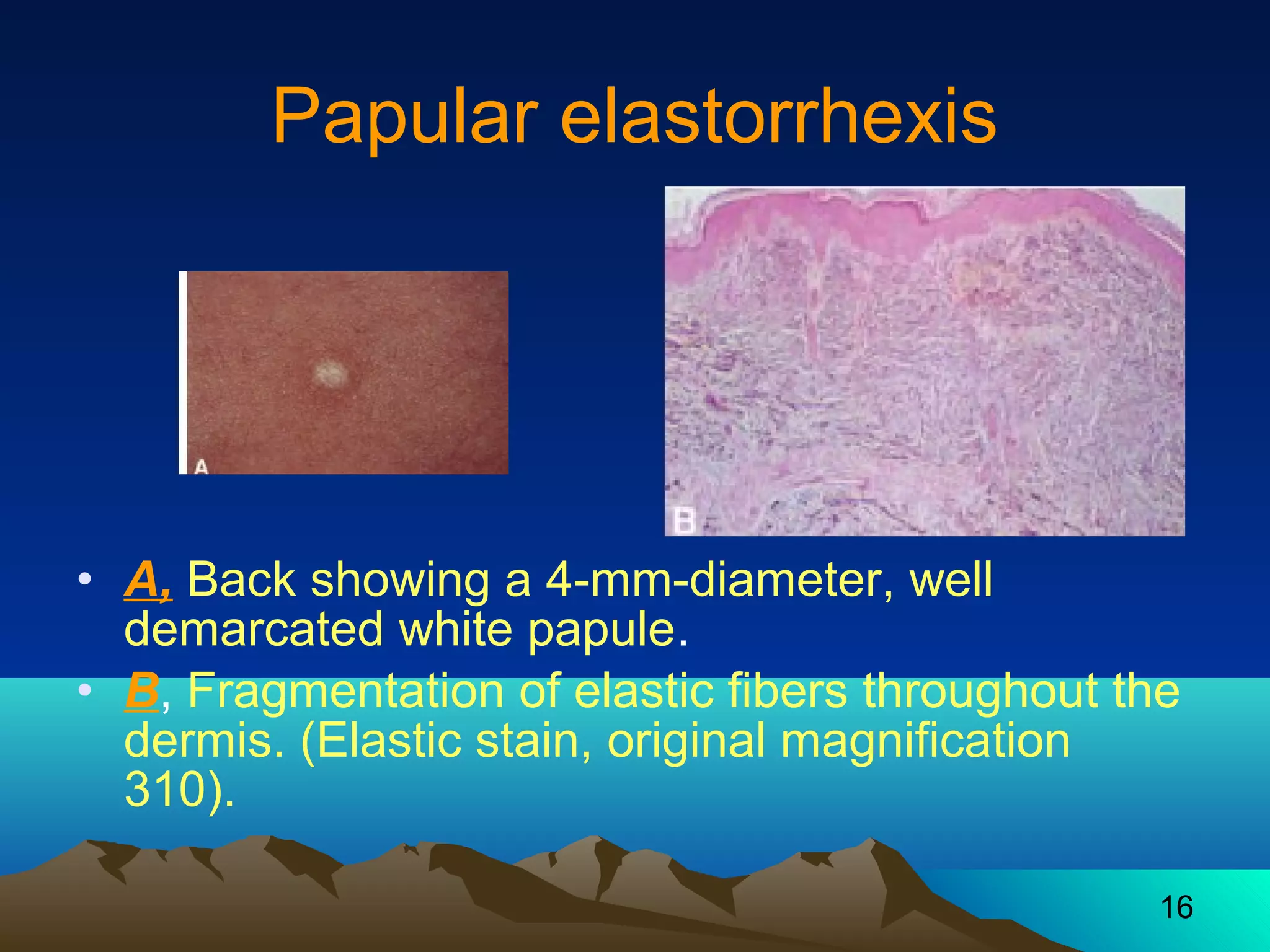 16 
Papular elastorrhexis 
• A, Back showing a 4-mm-diameter, well 
demarcated white papule. 
• B, Fragmentation of elastic fibers throughout the 
dermis. (Elastic stain, original magnification 
310). 
 