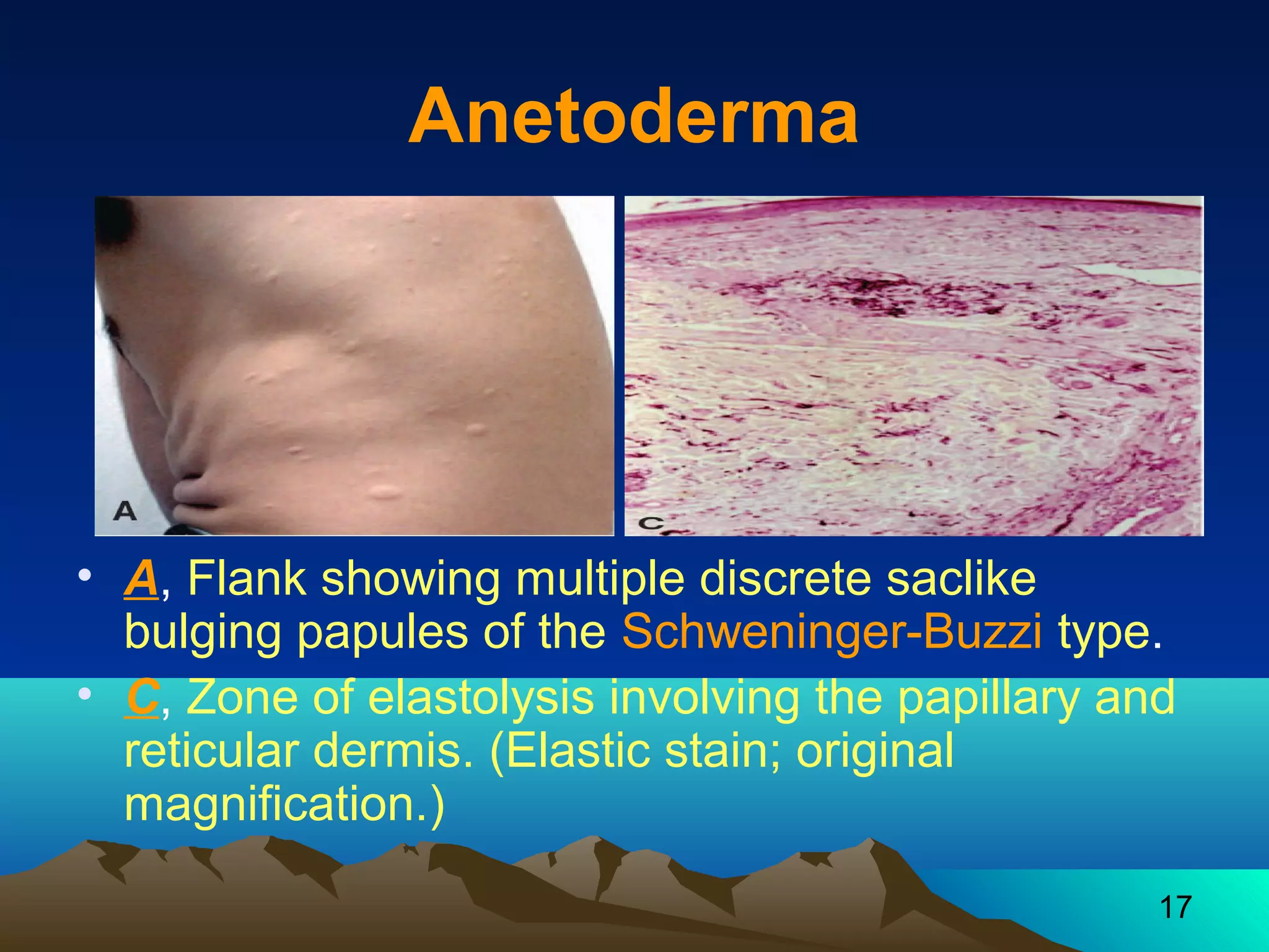 17 
Anetoderma 
• A, Flank showing multiple discrete saclike 
bulging papules of the Schweninger-Buzzi type. 
• C, Zone of elastolysis involving the papillary and 
reticular dermis. (Elastic stain; original 
magnification.) 
 