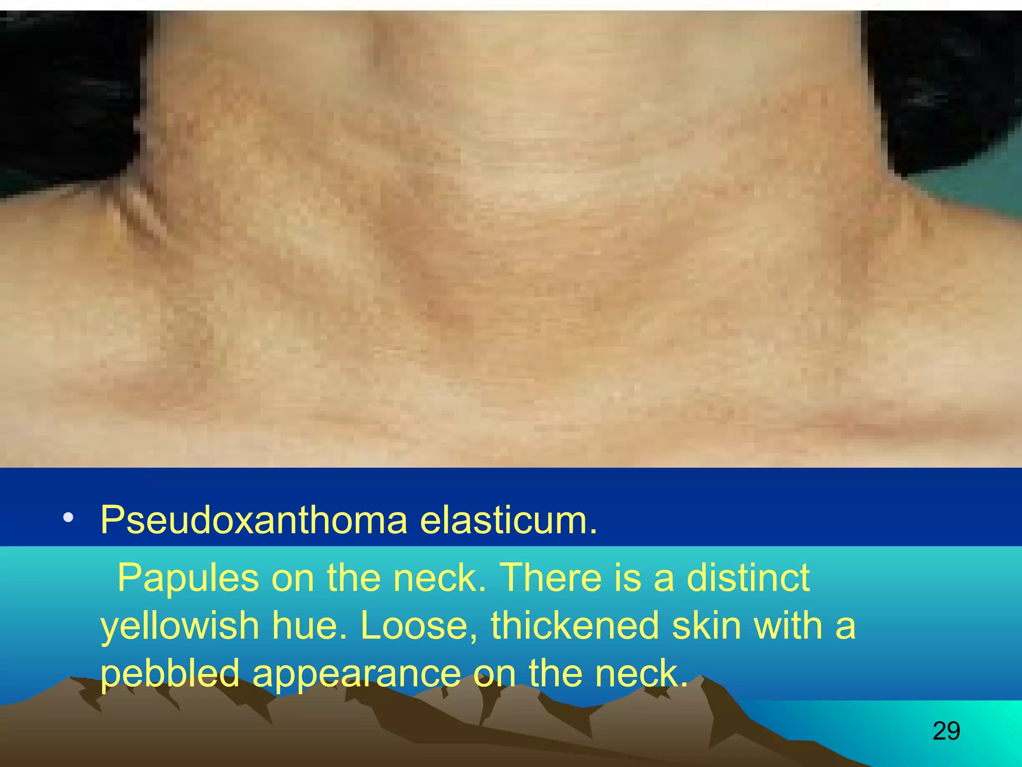 29 
• Pseudoxanthoma elasticum. 
Papules on the neck. There is a distinct 
yellowish hue. Loose, thickened skin with a 
pebbled appearance on the neck. 
 