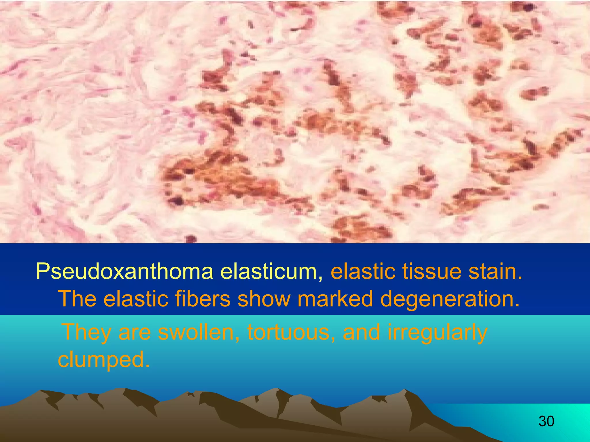 30 
Pseudoxanthoma elasticum, elastic tissue stain. 
The elastic fibers show marked degeneration. 
They are swollen, tortuous, and irregularly 
clumped. 
 