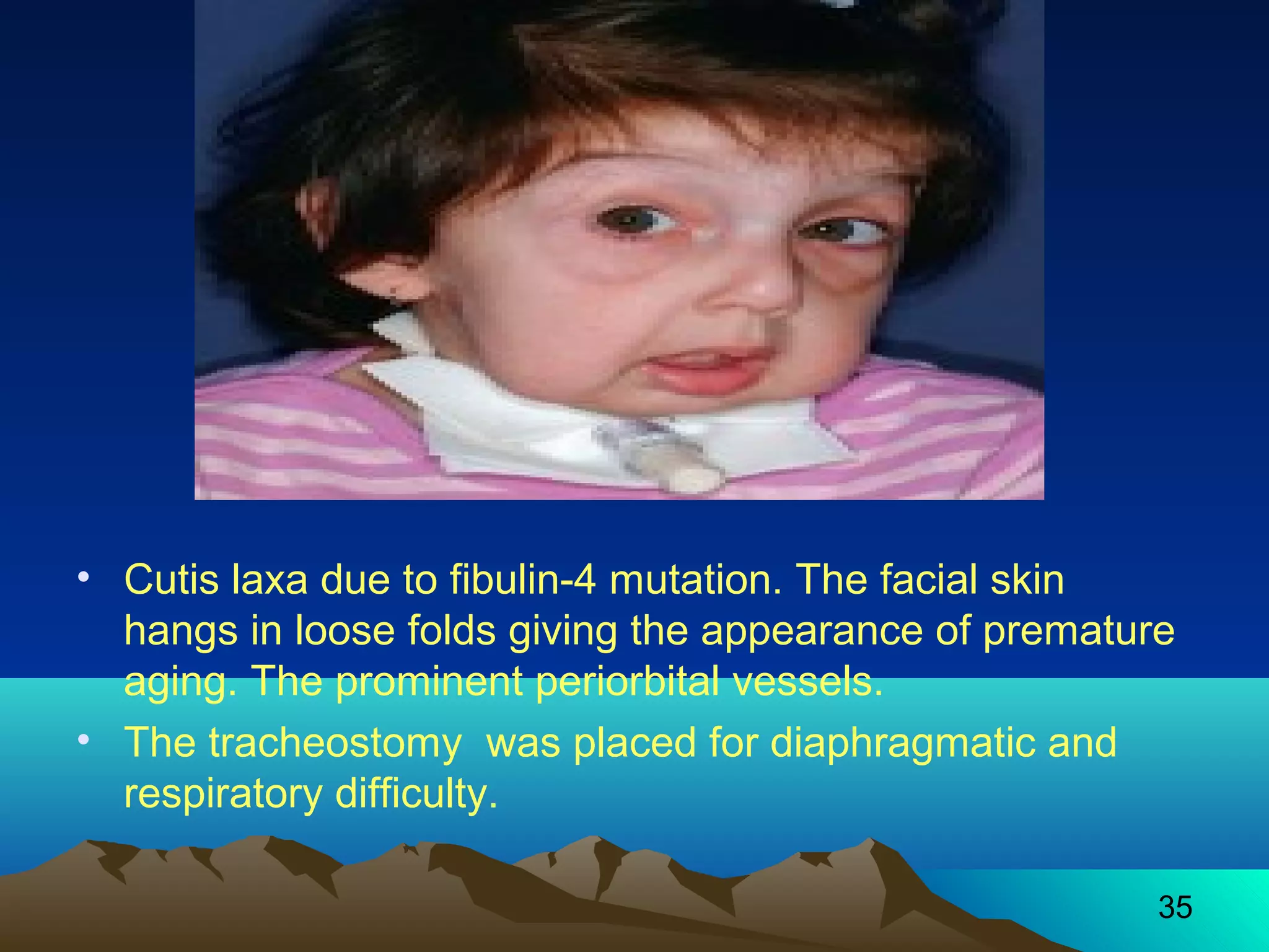 • Cutis laxa due to fibulin-4 mutation. The facial skin 
hangs in loose folds giving the appearance of premature 
aging. The prominent periorbital vessels. 
• The tracheostomy was placed for diaphragmatic and 
respiratory difficulty. 
35 
 